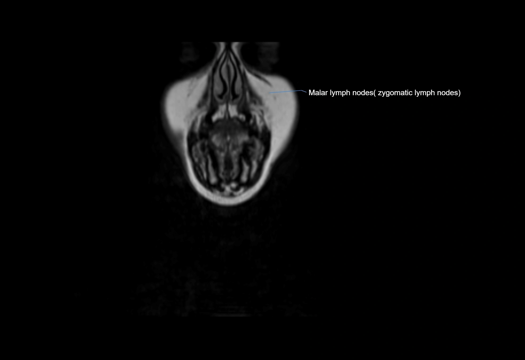 Neck coronal lymph node cross sectional MRI anatomy 3T MRI  image-img-00001-00072.webp